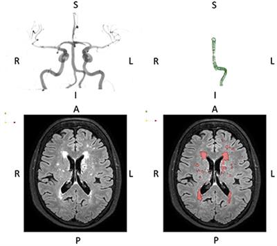 Accelerated vascular aging: Ethnic differences in basilar artery length and diameter, and its association with cardiovascular risk factors and cerebral small vessel disease